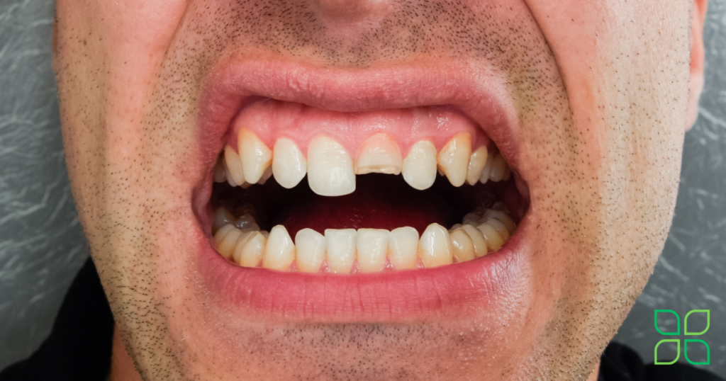 fractured teeth from bruxism