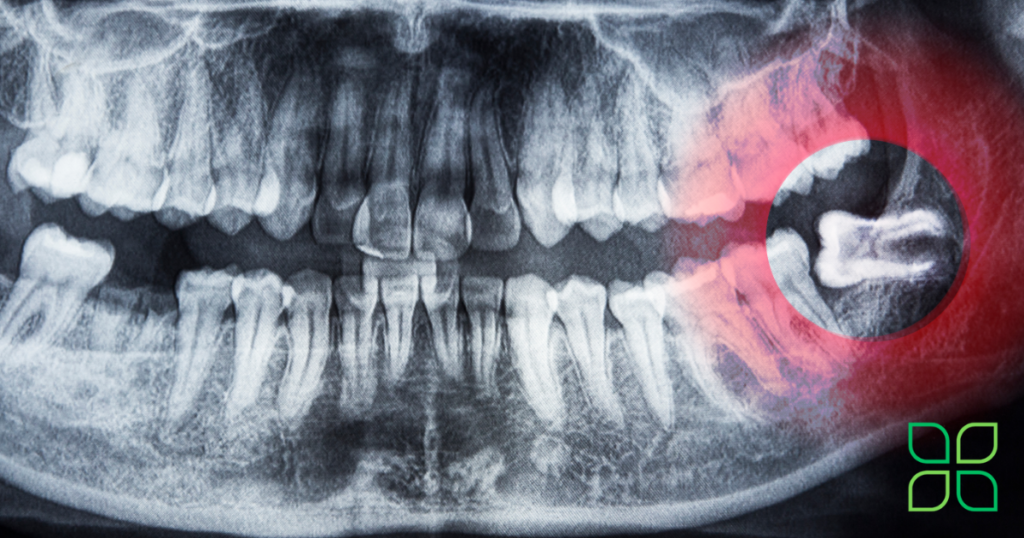 pericoronitis treatment