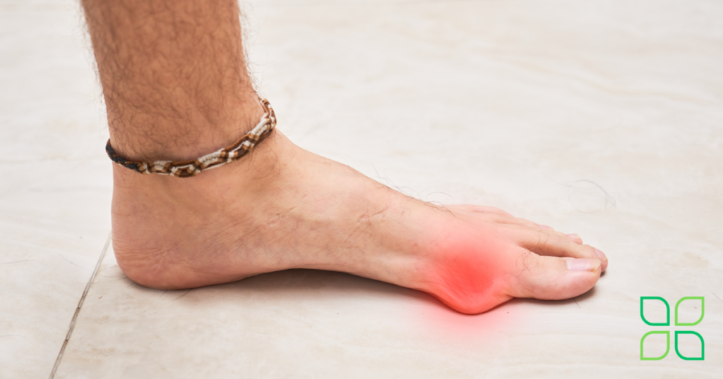 natural remedies for bunion pain