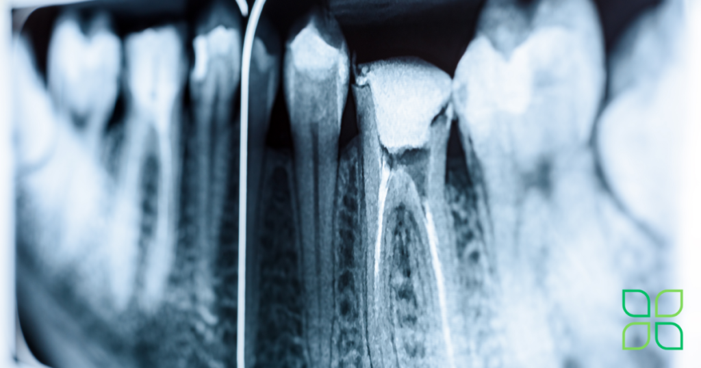 reduce root canal pain