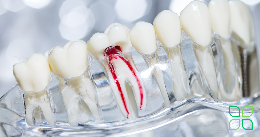 treating root canal pain