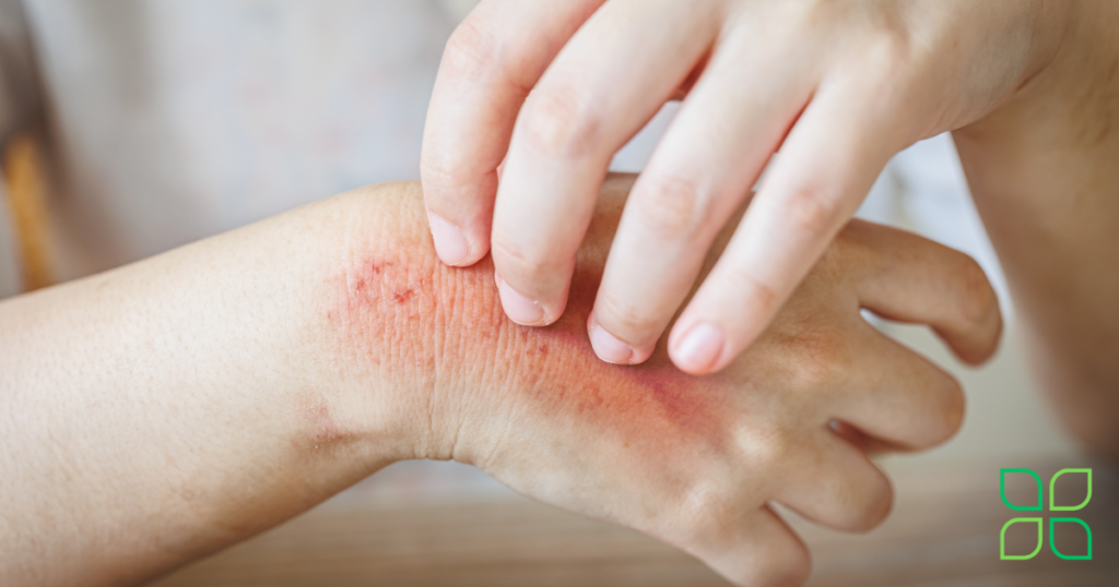 a red and irritated hand being scratched because of allergies