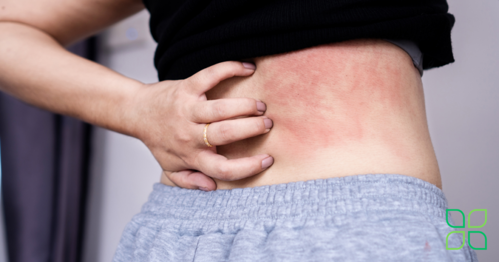 a woman's back with a itchy rash