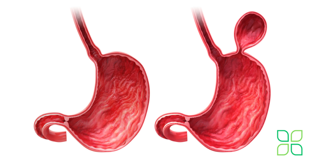 diagram of a hernia